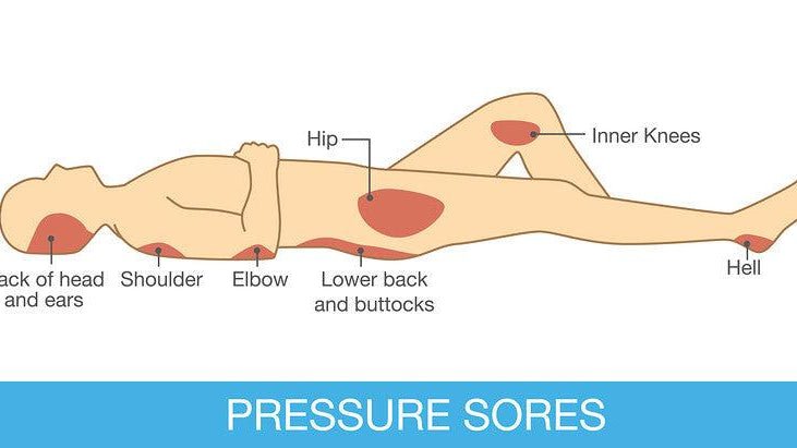 Dealing with Pressure Sores - RUSTIC